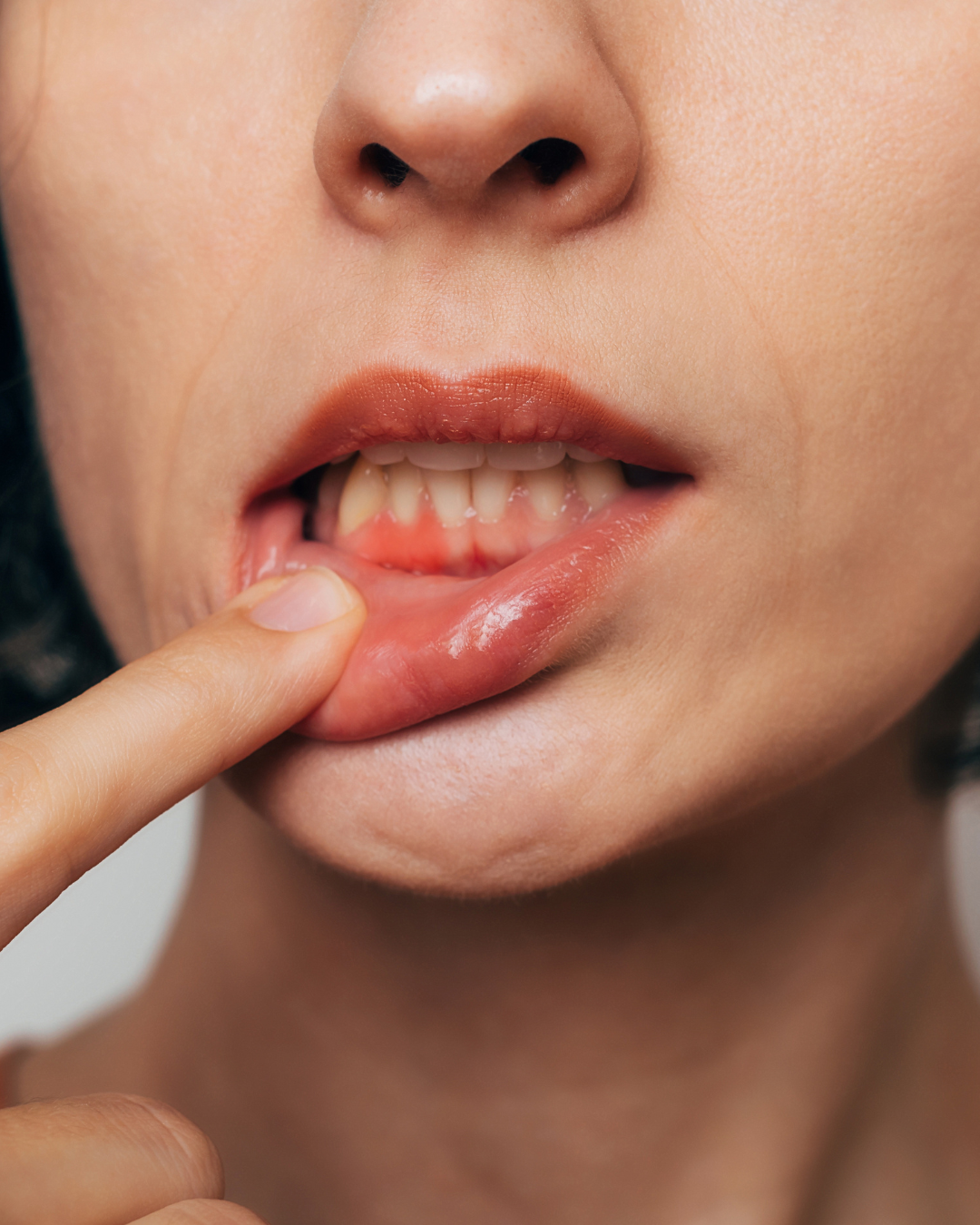 How to stop bleeding and receding gums